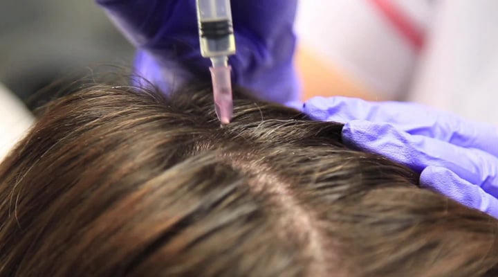 GRP (Growth Factor Rich Plasma)